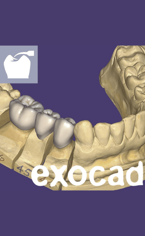 Exocad DentalCAD