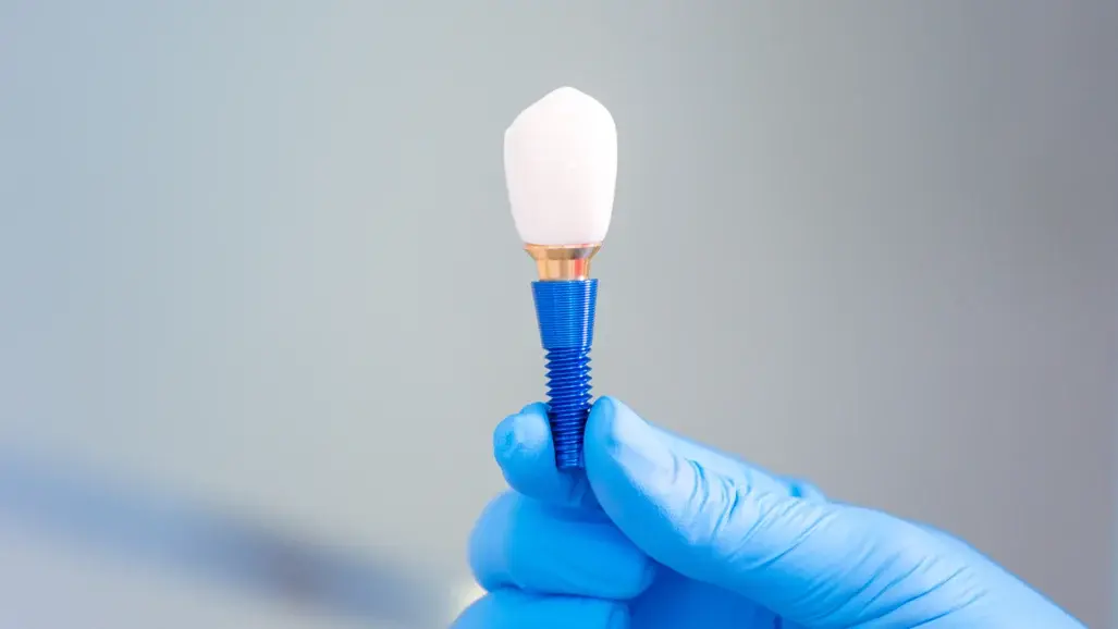 Gli impianti dentali dimostrano longevità e continuità di funzionamento dopo quattro decenni